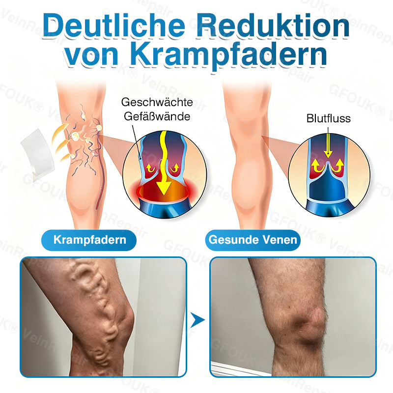 🇩🇪🥇🏆GFOUK® VeinRepair Mikronadel-Pflasterrolle⚡Sofortige Linderung, langfristige Ergebnisse