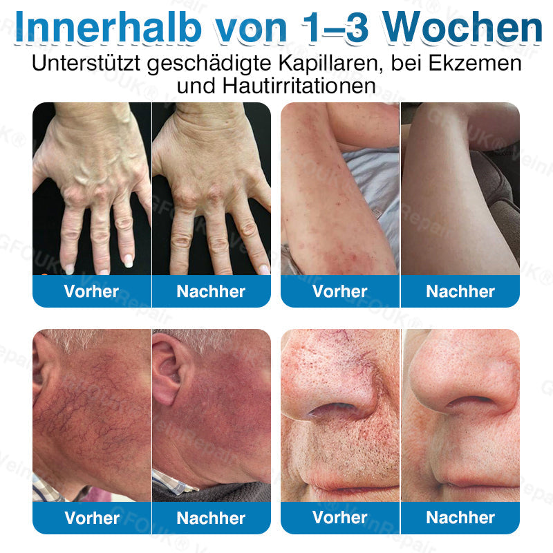 GFOUK® VeinRepair Mikronadel-Pflasterrolle⚡