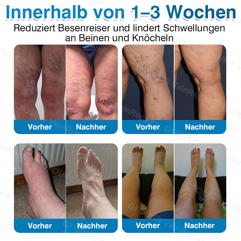 🇩🇪🥇🏆GFOUK® VeinRepair Mikronadel-Pflasterrolle⚡Sofortige Linderung, langfristige Ergebnisse