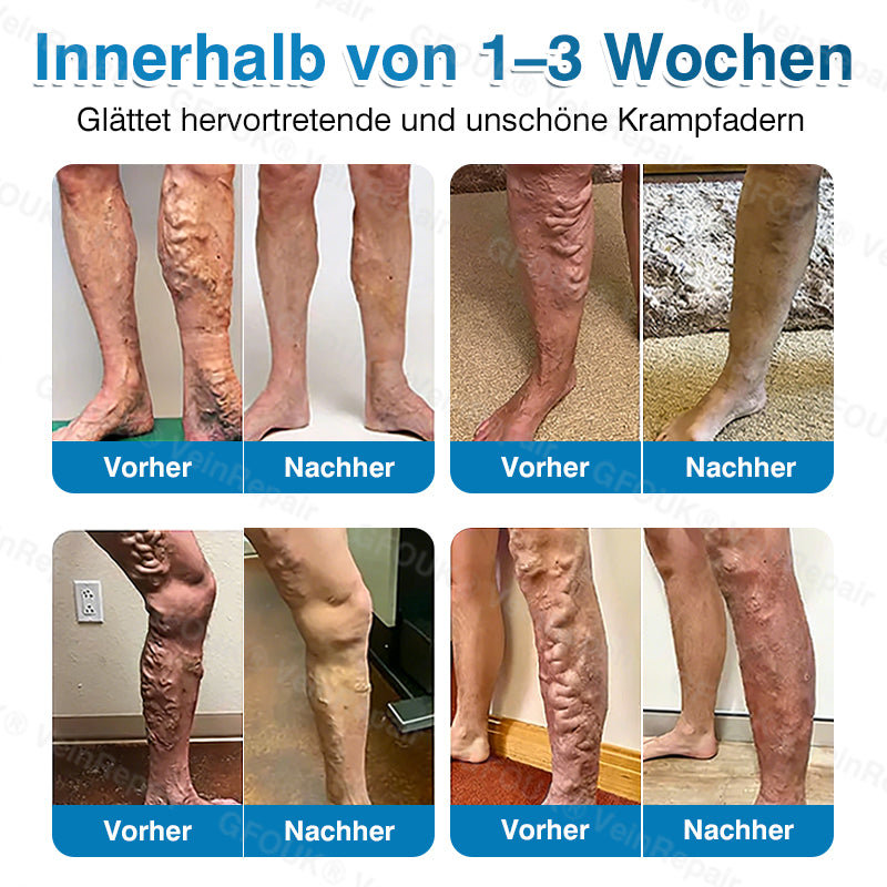 🇩🇪🥇🏆GFOUK® VeinRepair Mikronadel-Pflasterrolle⚡Sofortige Linderung, langfristige Ergebnisse