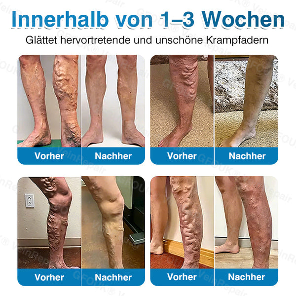 🇩🇪🥇🏆GFOUK® VeinRepair Mikronadel-Pflasterrolle⚡Sofortige Linderung, langfristige Ergebnisse