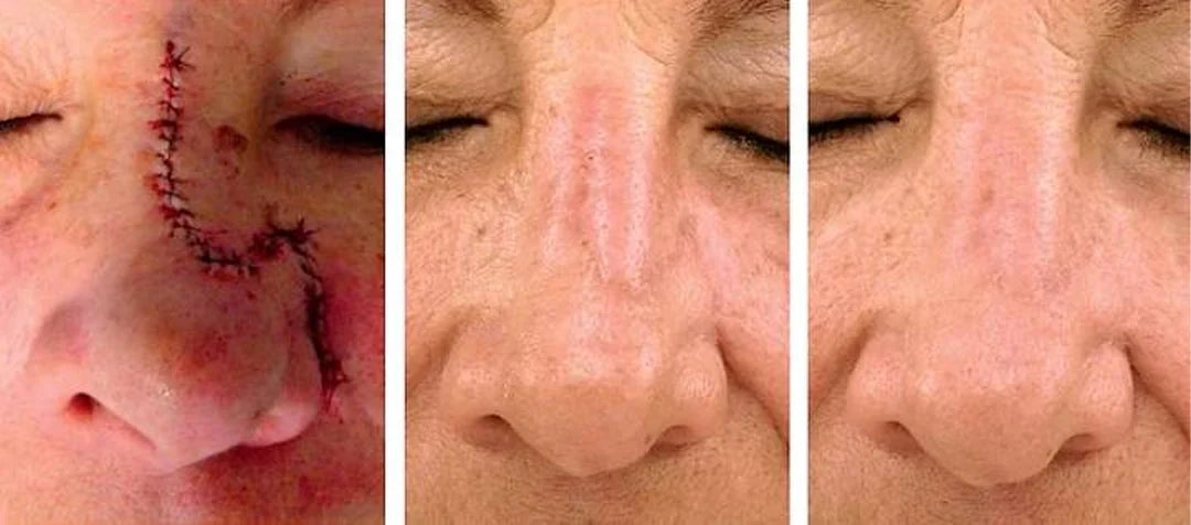 Revella™ Narbenpflege-Gel – Für Ein Ebenmäßigeres & Gepflegteres Hautbild