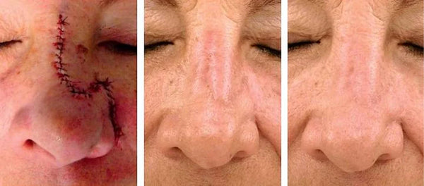 Revella™ Narbenpflege-Gel – Für Ein Ebenmäßigeres & Gepflegteres Hautbild