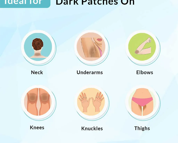 DermaPflege™ Acanthosis Nigricans Hyperpigmentierung Therapie Creme