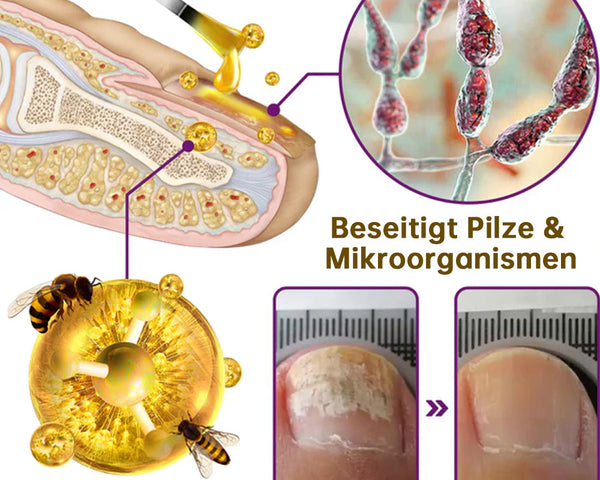 1+1 GRATIS | 🛡️ PilzSchutzschild™ – Sag Nagelpilz den Kampf an!