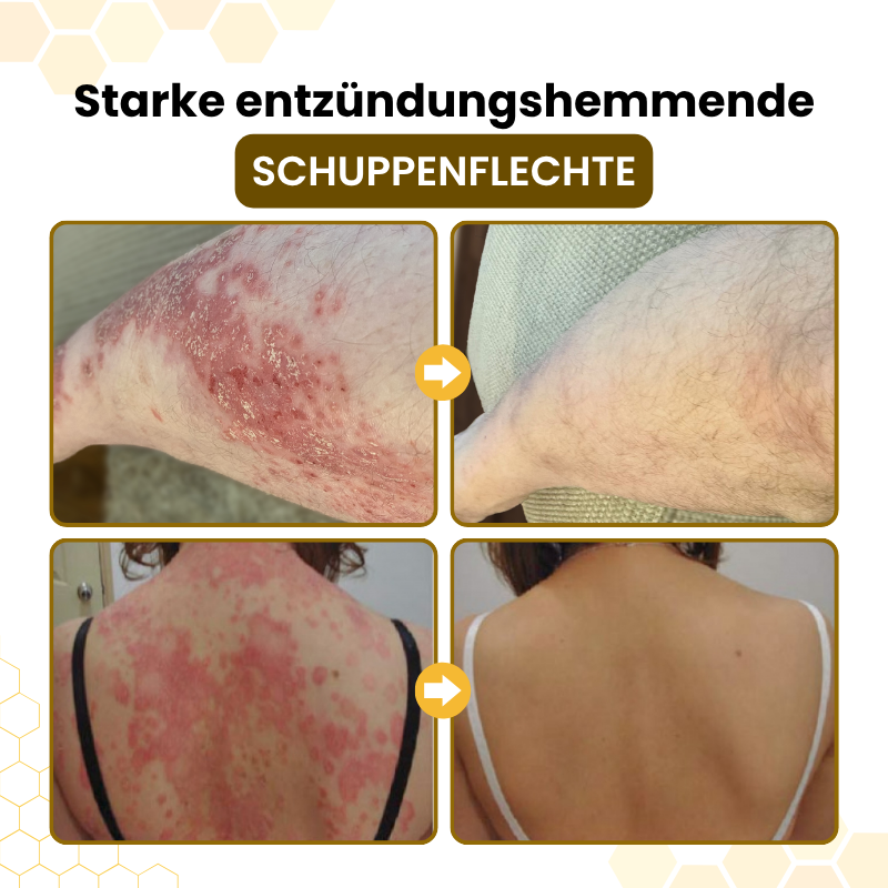 PsoriaSoothe Fortschrittliche Bienengift Haut-Regenerationscreme