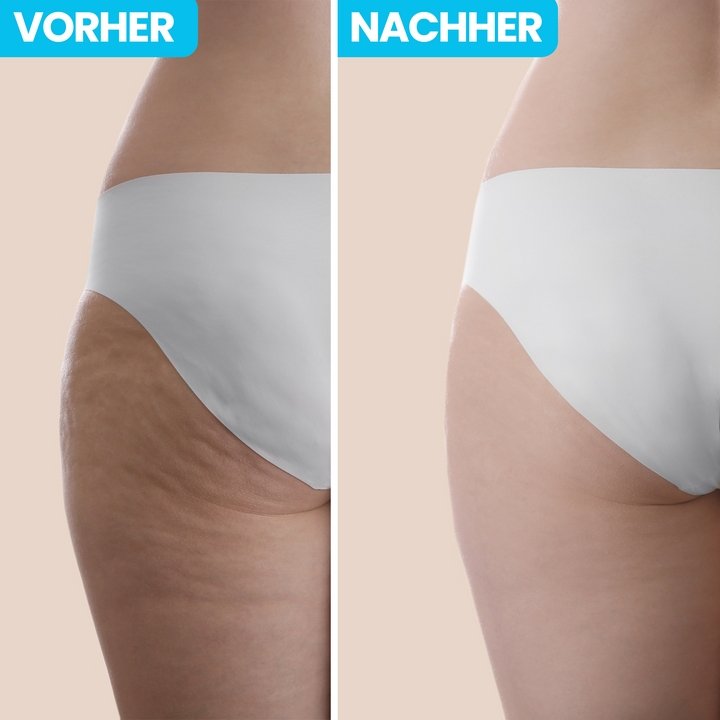 60% Rabatt | Inovagoods™️ 5-in-1 Anti-Cellulitis Infrarot-Massagegerät