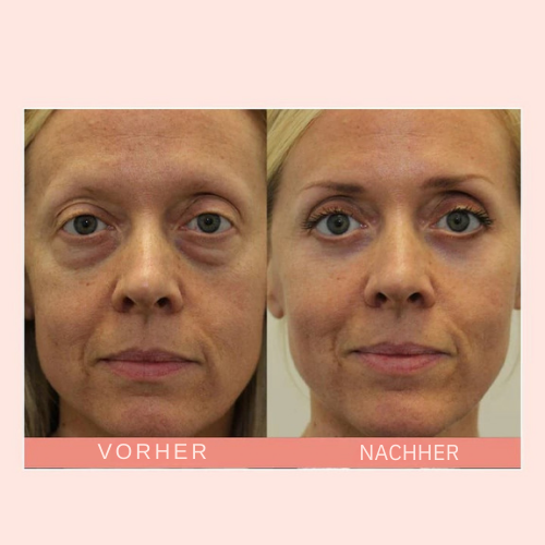 2+1 Gratis | JugendlicherBalken™ Glatte und strahlende Augen