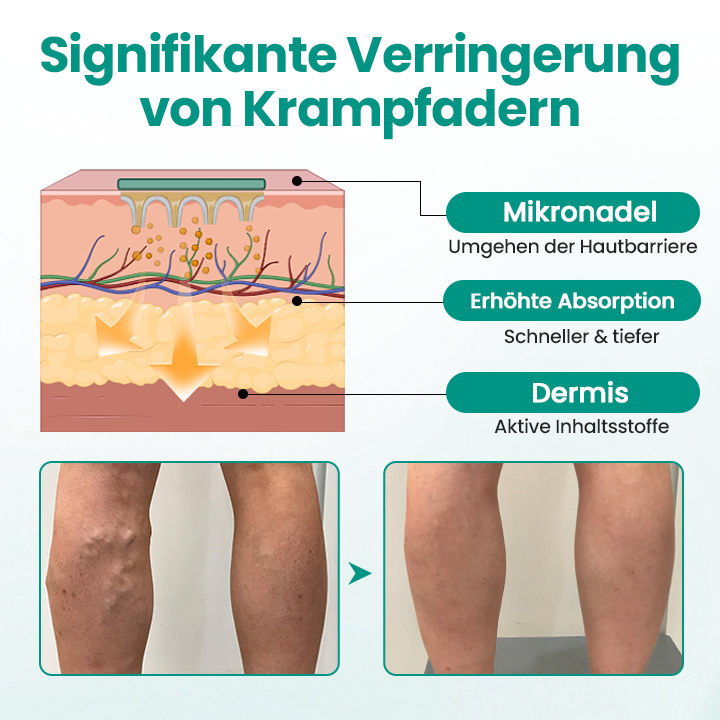 LegRenew™ Krampfaderpflaster