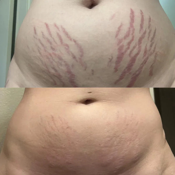 Revella™ Narbenpflege-Gel – Für Ein Ebenmäßigeres & Gepflegteres Hautbild