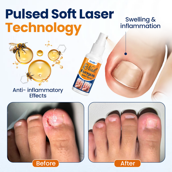 NailForte™ Nagelpilz-Spray – Schnelle Hilfe für gesunde & klare Nägel