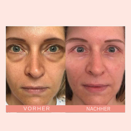 2+1 Gratis | JugendlicherBalken™ Glatte und strahlende Augen