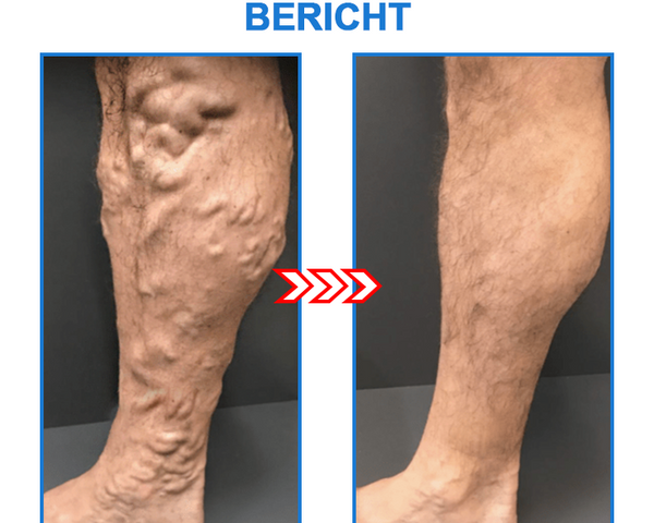 TourmaCare™ – Straffere Haut & Weniger Cellulite | Jetzt 1+1 Gratis!