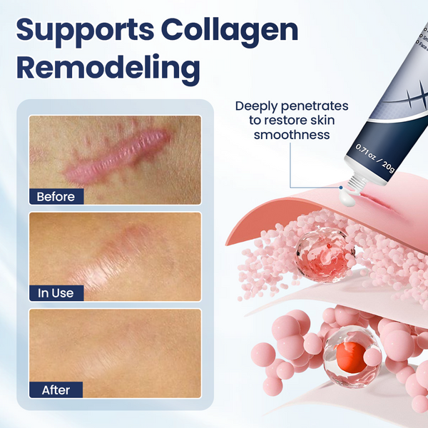 Revella™ Narbenpflege-Gel – Für Ein Ebenmäßigeres & Gepflegteres Hautbild