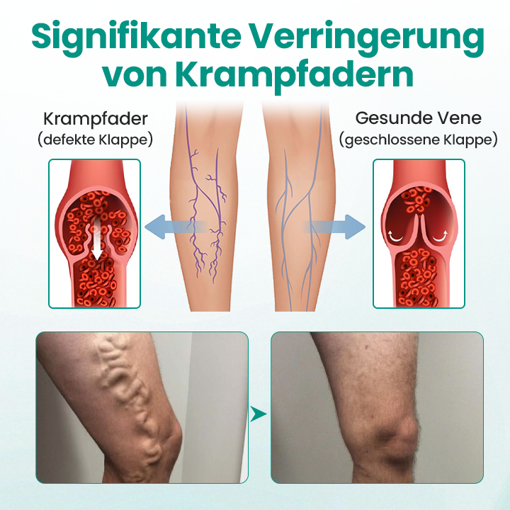 LegRenew™ Krampfaderpflaster
