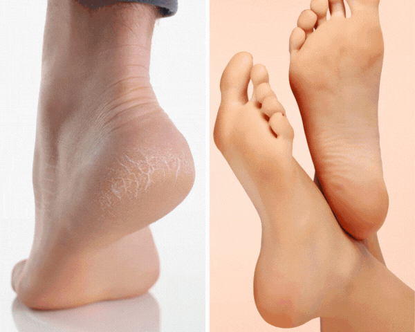 MagicPedi™️ – Seidig glatte Füße wie vom Profi – Jetzt zu Hause genießen