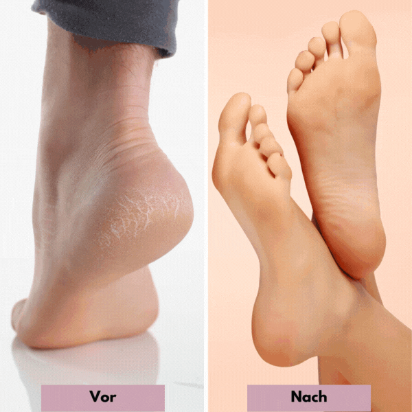 MagicPedi™️ – Seidig glatte Füße wie vom Profi – Jetzt zu Hause genießen