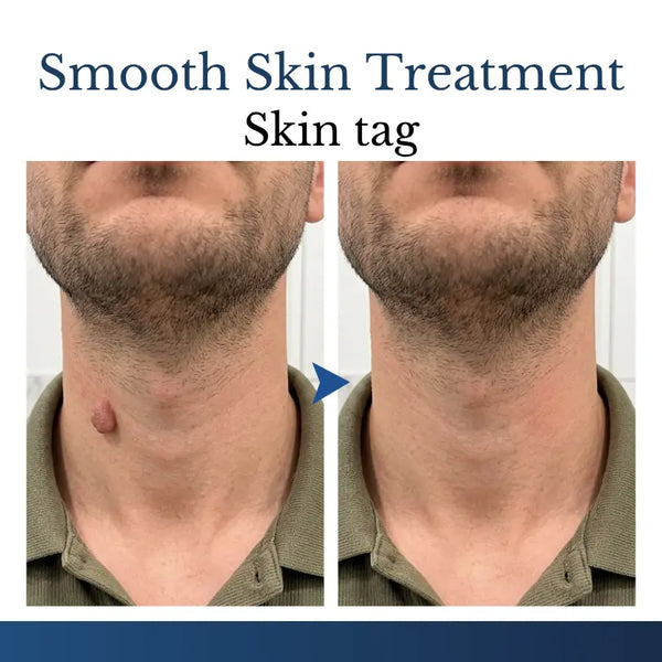 DermaVelle™ 2-in-1 Mikronadel-Pflaster – Für sichtbar glattere Haut & weniger Hautanhängsel