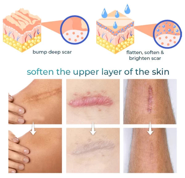 RenewScar™ Fortschrittliche Narbenbehandlung