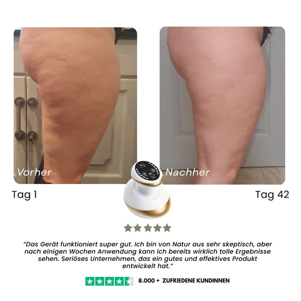 VelaSculpt™ Anti-Cellulite