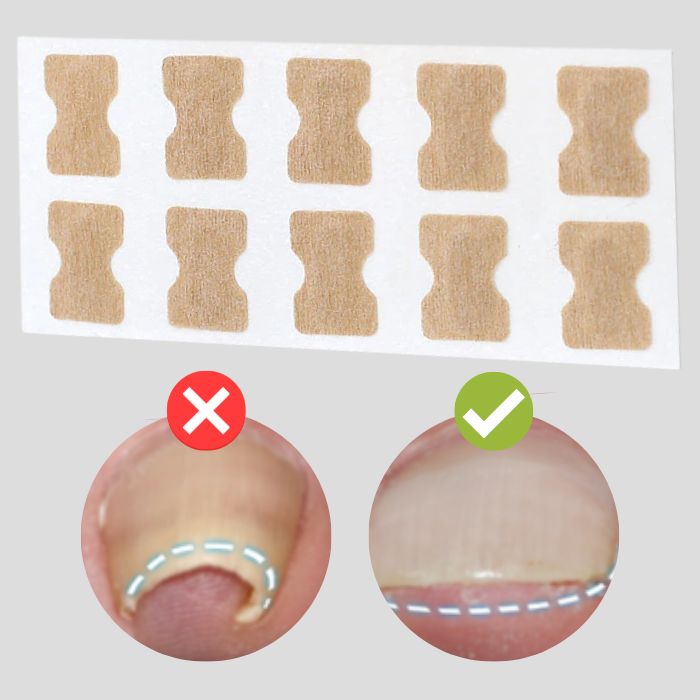 50% Rabatt || NagelWunder™ | Professionelle Korrekturpflaster für schöne, gesunde Nägel