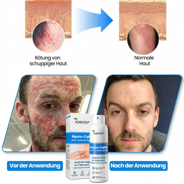 Magnesium Kräuter-Spray für Psoriasis-neigende Haut