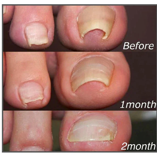 10+10 GRATIS | FixaNail - Sofortige Nagelreparatur
