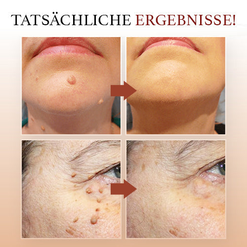 WipeClear™ Tags & Maulwurfsentferner (1+1 Gratis)