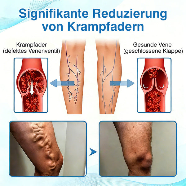 🇩🇪🏃‍🌿GFOUK® VascuCare Vein Healing Spray(Entwickelt für Krampfadern, Besenreiser, tiefe Venenthrombose (TVT), chronische venöse Insuffizienz, venöse Geschwüre, Thrombophlebitis und andere venöse Beschwerden)