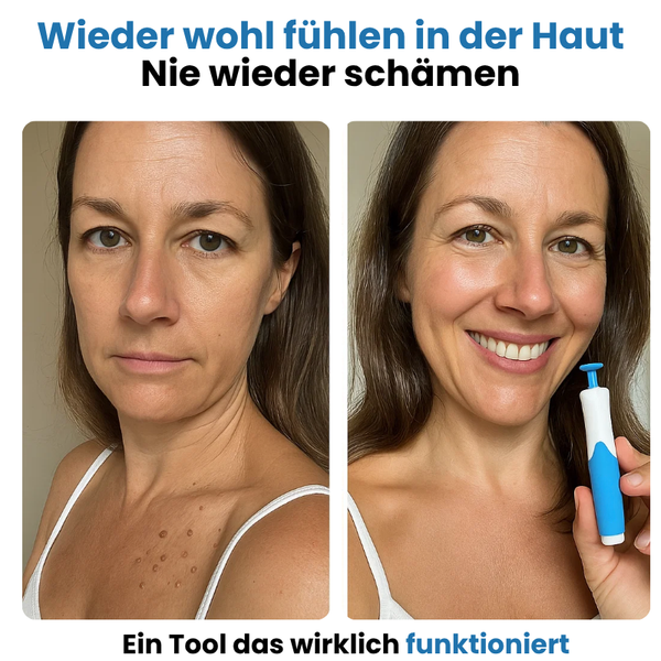 ALCURA™ - Glatte Haut in nur 4 Tagen