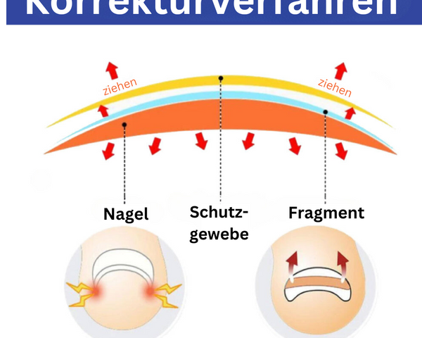 ToeCare™ - Ihre Lösung für eingewachsene Zehennägel!