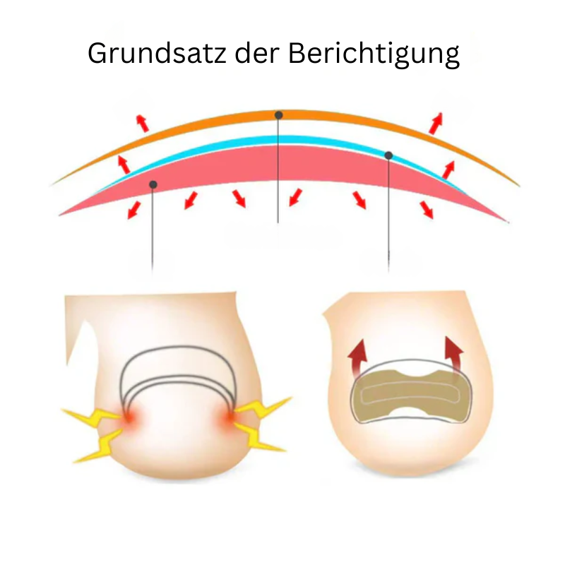 NailCare™ Sanfte Nagelkorrektur-Aufkleber