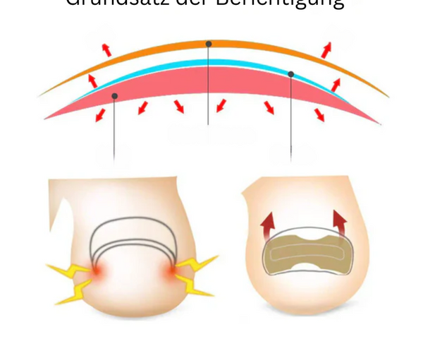 NailCare™ Sanfte Nagelkorrektur-Aufkleber