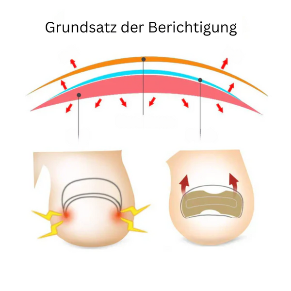 NailCare™ Sanfte Nagelkorrektur-Aufkleber