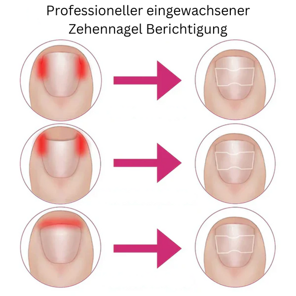 NailCare™ Sanfte Nagelkorrektur-Aufkleber