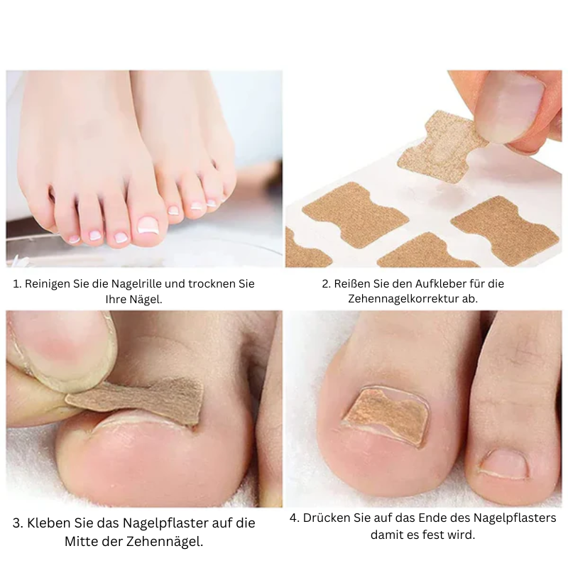 NailCare™ Sanfte Nagelkorrektur-Aufkleber