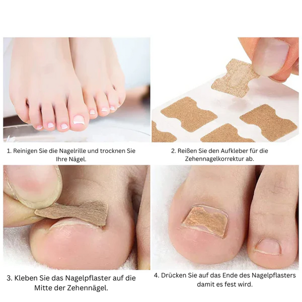 NailCare™ Sanfte Nagelkorrektur-Aufkleber