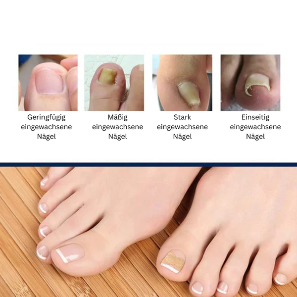 NailCare™ Sanfte Nagelkorrektur-Aufkleber