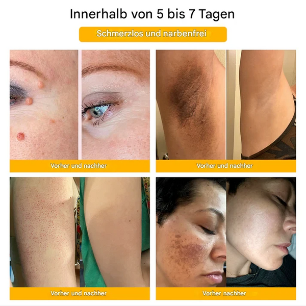 TagFree™ Warzen- & Hautanhängsel Pflege – Für Ein Ebenmäßigeres Hautbild