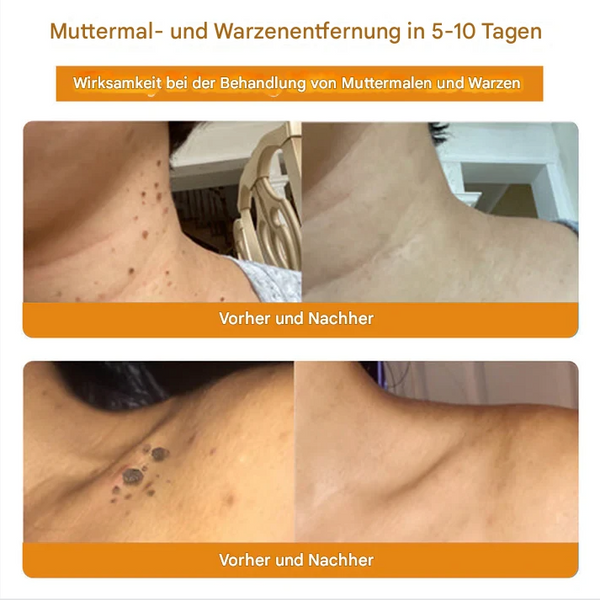 TagFree™ Warzen- & Hautanhängsel Pflege – Für Ein Ebenmäßigeres Hautbild