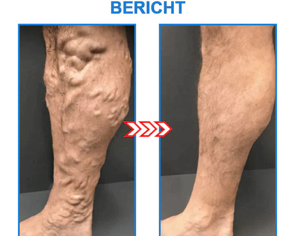 FormSocken™ - Schlanke Beine und straffe Haut in einem Schritt!