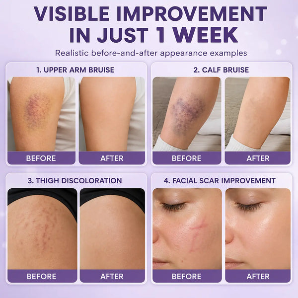 BruiseLuxe™ Hautregenerationscreme – Für Weniger Sichtbare Blutergüsse & Ein Ebenmäßigeres Hautbild