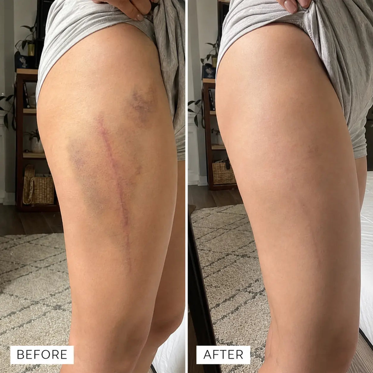 BruiseLuxe™ Hautregenerationscreme – Für Weniger Sichtbare Blutergüsse & Ein Ebenmäßigeres Hautbild