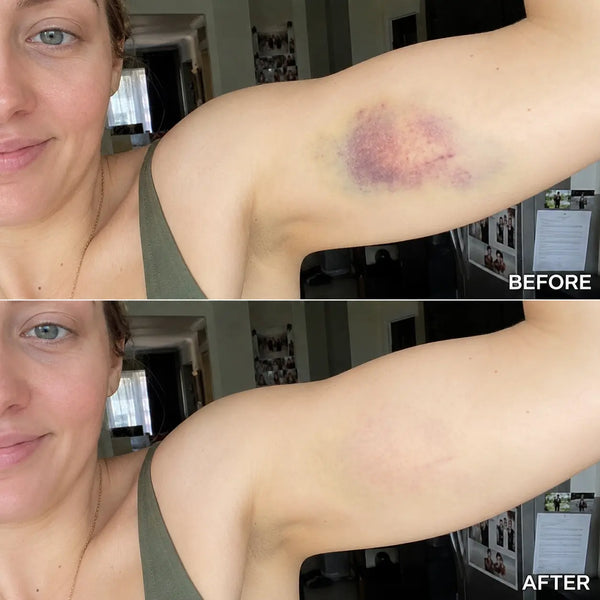 BruiseLuxe™ Hautregenerationscreme – Für Weniger Sichtbare Blutergüsse & Ein Ebenmäßigeres Hautbild