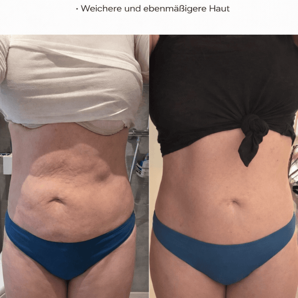 50% Rabatt | Vacumify Cellulite-Stop™ | Glattere & straffere Haut in nur 14 Tagen – von Zuhause aus!
