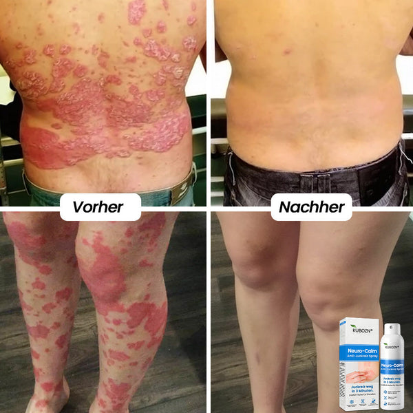 Magnesium Kräuter-Spray für Psoriasis-neigende Haut