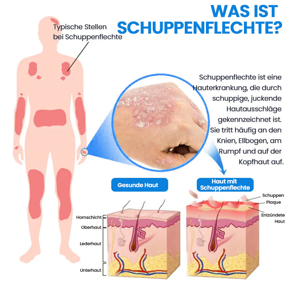 Magnesium Kräuter-Spray für Psoriasis-neigende Haut