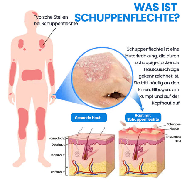 Magnesium Kräuter-Spray für Psoriasis-neigende Haut