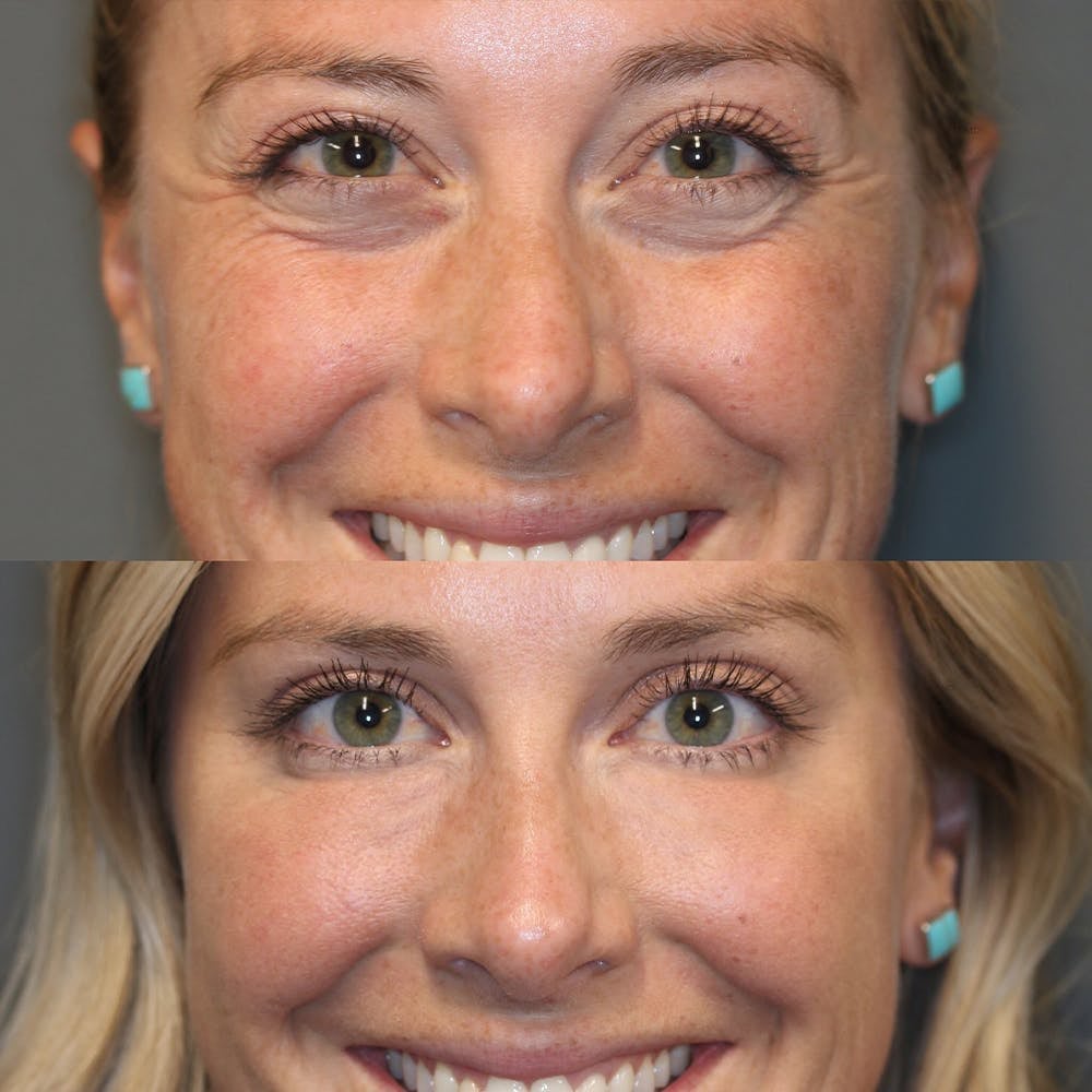 2+1 Gratis | JugendlicherBalken™ Glatte und strahlende Augen