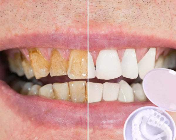 Snap-on Zähne™ - Mit diesen Veneers immer das perfekte Lächeln